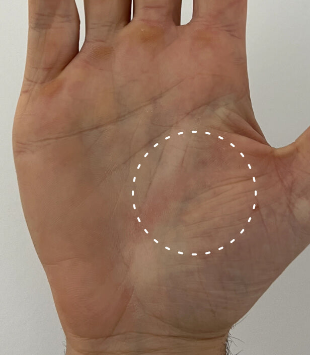 Image of hand with a recent burn on the palm but it has healed significantly